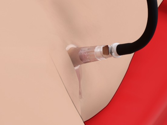 Picture of Clitoris Pumping System